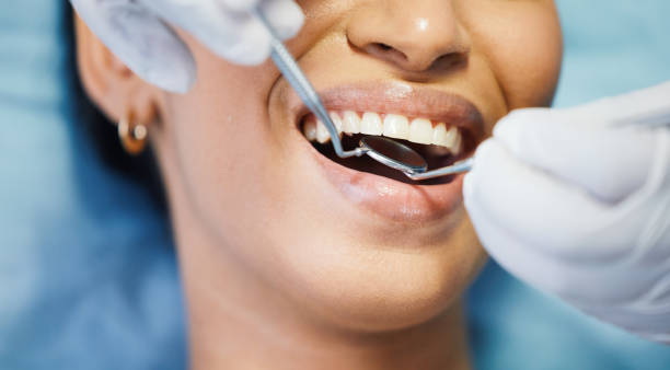 Best Knocked-Out Tooth (Avulsed Tooth) Treatment in Spanish Fork, UT