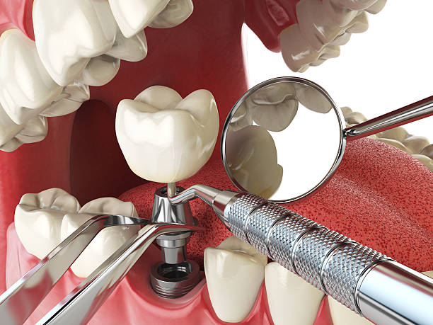Best Emergency Dental Care for Sports Injuries in Spanish Fork, UT